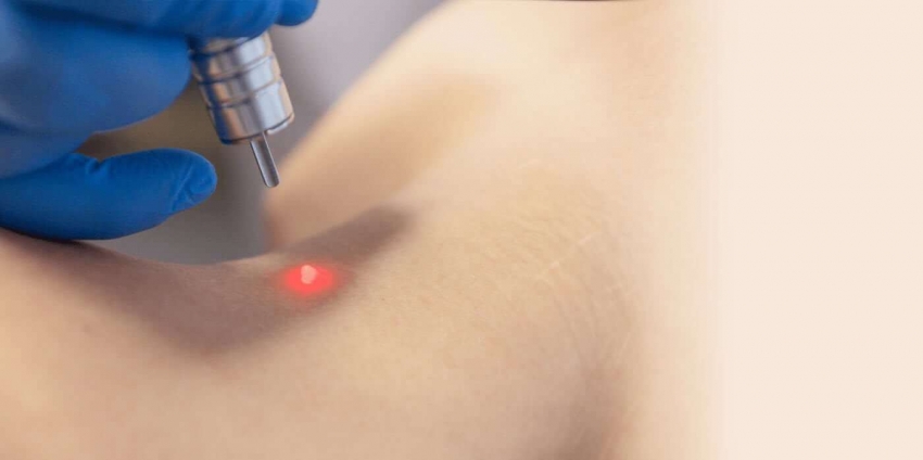 Лазерное удаление папиллом в Киеве можно в клинике LaserOne