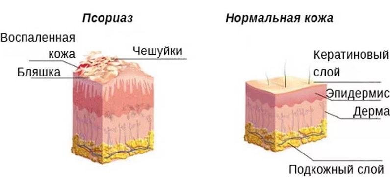Избавление от бляшек псориаза